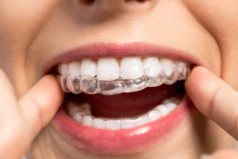 blog - aorati orthodontiki