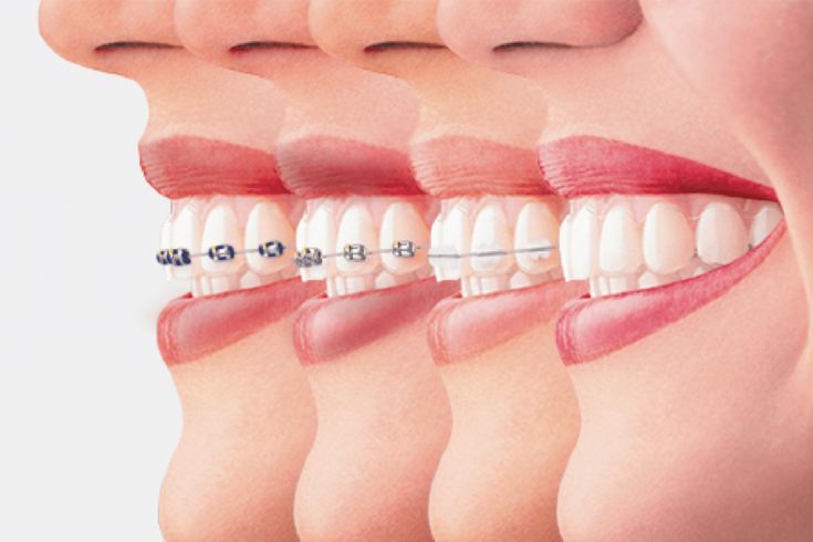 Braces vs. Invisalign: Which is Right for You?
